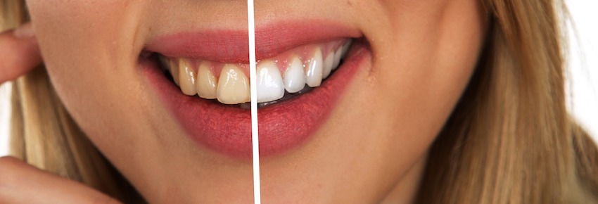 เปลี่ยนฟันเหลืองให้กลายเป็นฟันขาวด้วยมูสฟอกฟันขาว