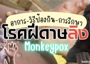 โรคฝีดาษลิง (โรคฝีดาษวานร) monkeypox